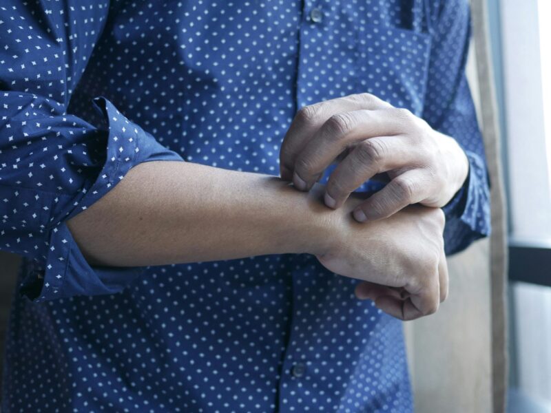 Experiencing Allergy Symptoms?Is Skin Prick Test the Right Choice in Dubai?